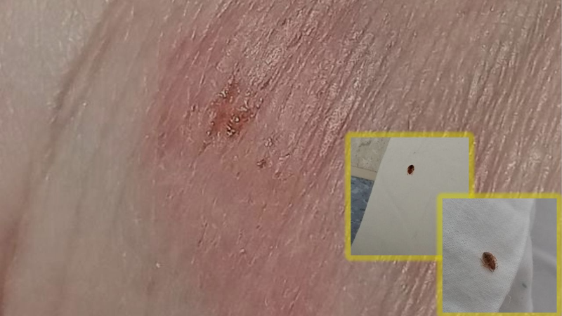 Hastanede "tahta kurusu" iddiası: Bir hasta ısırıldığını öne sürdü